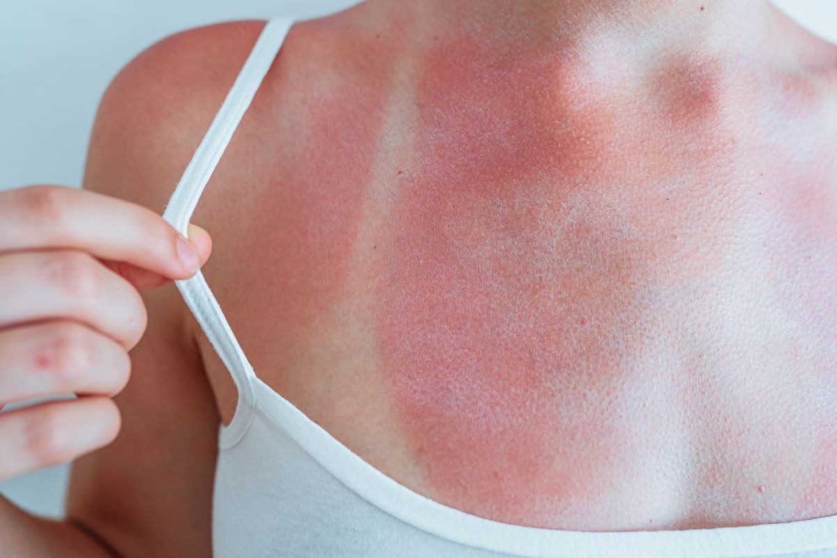 Sonnenbrand im Bodenseekreis: Richtig vermeiden, schnell beh